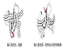 输入袢综合征