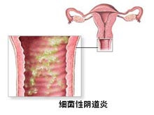 细菌性阴道炎