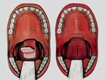 腭咽闭合不全