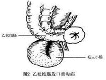 乙状结肠造口旁沟疝