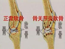 痛风性关节炎