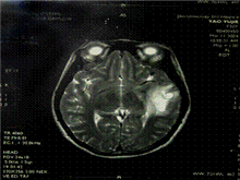 原发性腹膜癌