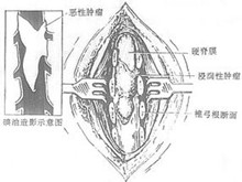 小儿椎管内肿瘤