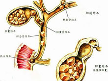 胆管结石伴胆管炎
