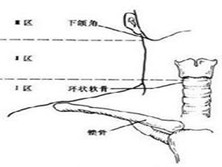 颈部火器性异物