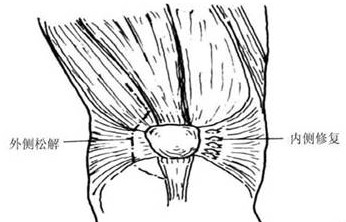 复发性髌骨脱位