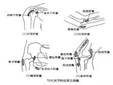 棘突滑囊炎