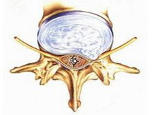 极外侧型腰椎间盘突出症