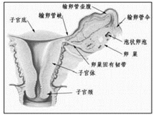 原发性卵巢绒癌