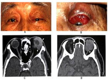 眼眶非霍奇金恶性淋巴肿瘤