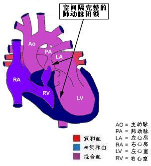 肺动脉闭锁