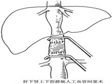 腹部大血管损伤