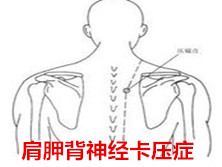 肩胛背神经卡压症