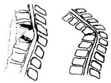 脊椎结核后突畸形