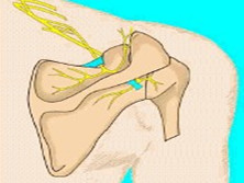 肩胛上神经卡压症