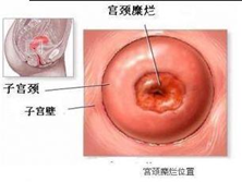 阿米巴性宫颈炎