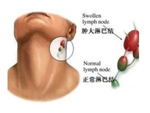 淋巴结核