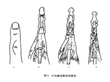 手部伸肌腱损伤