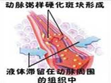 高脂血症