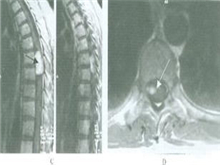 原发性椎管内肿瘤