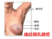 绝经期乳腺癌