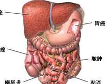 腹腔脓肿