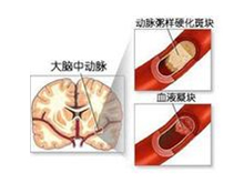 腔隙性脑梗塞