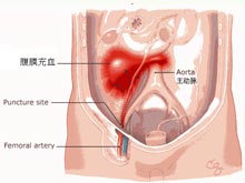 腹膜后血肿