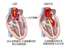 风湿性心脏瓣膜病