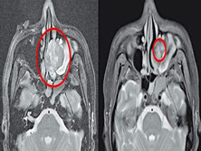 鼻肿瘤
