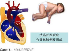 法乐四联症