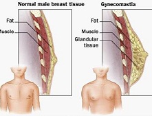 男性乳腺发育症