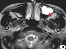 鼻窦粘膜囊肿