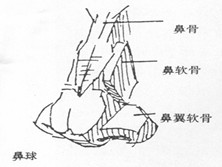 鼻骨瘤