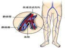 静脉血栓形成