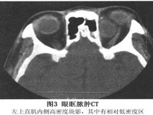 眼眶脓肿