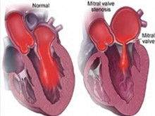 风湿性二尖瓣狭窄