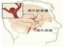 颅内动脉瘤