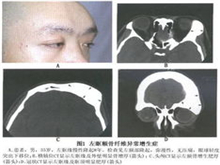 眼眶骨纤维异常增殖症