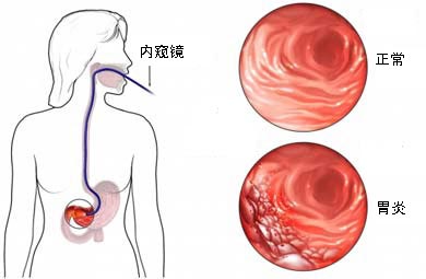 胃炎