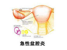 急性盆腔炎