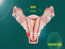 输卵管性不孕