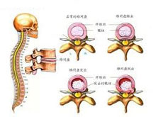 椎间盘突出症