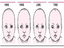 急性共同性斜视