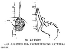 膈下食管憩室