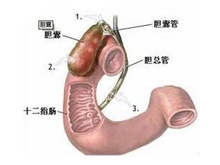 多发性胆囊息肉