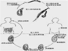 肺部钩虫病