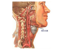 颈动脉狭窄