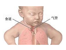 小儿支气管炎