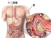 消化道出血